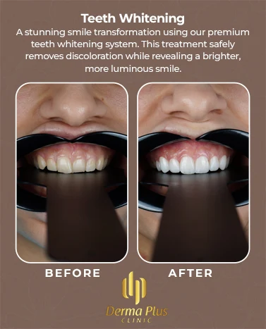 teethwhitening01